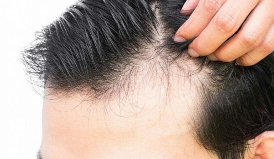 Hair Loss and The Flaws with Current Treatments