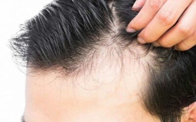 Hair Loss and The Flaws with Current Treatments