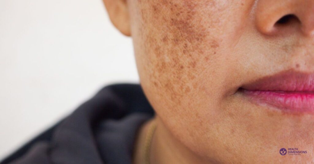 Compounded cream medications Rx prescription for Dark spots (Melasma) from HDRX, Michigan compounding pharmacy