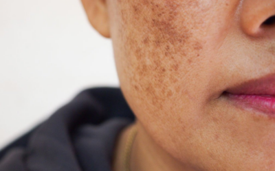Dark Spots On Skin (aka Melasma) – A Compounded Rx Treatment