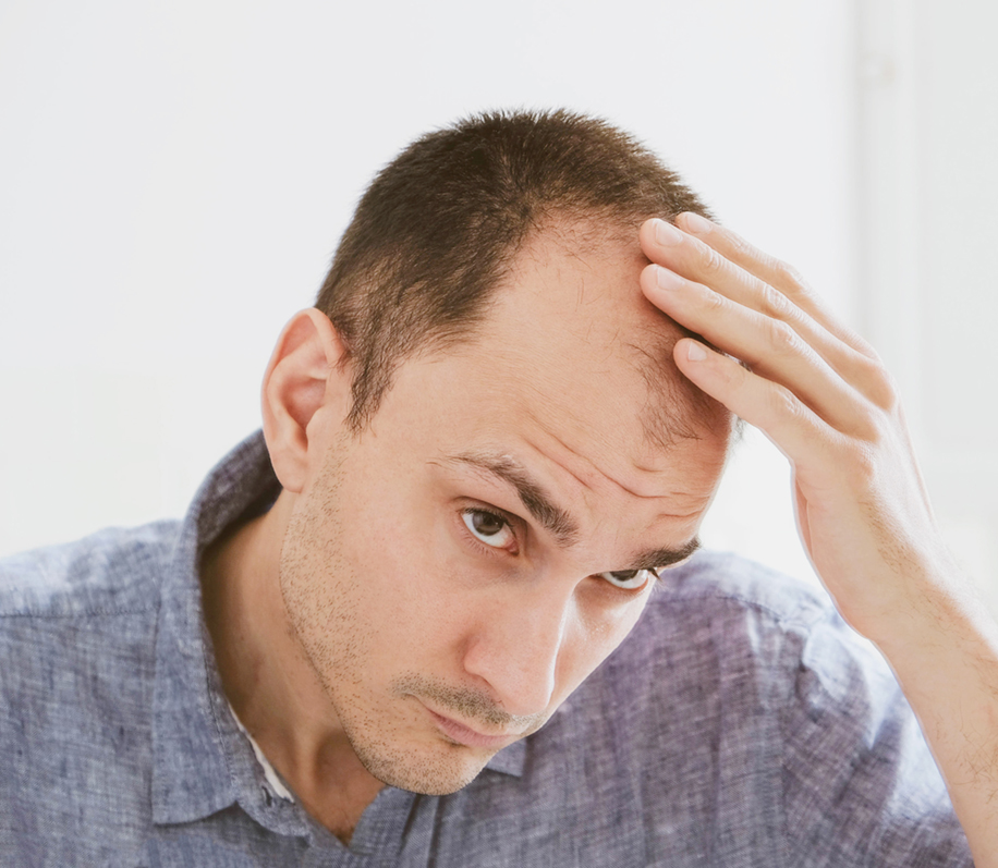 Man experiencing Androgenic Alopecia