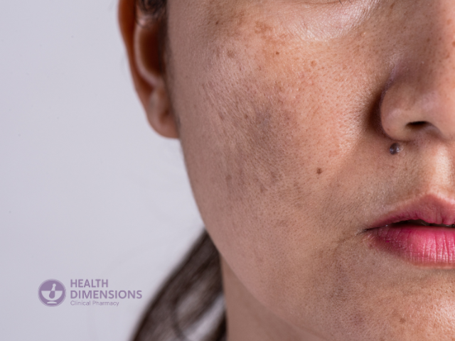 Metformin Melasma: Woman's Face