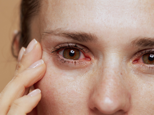 Woman with Dry Eye Disease in Need of Gabapentin Medication